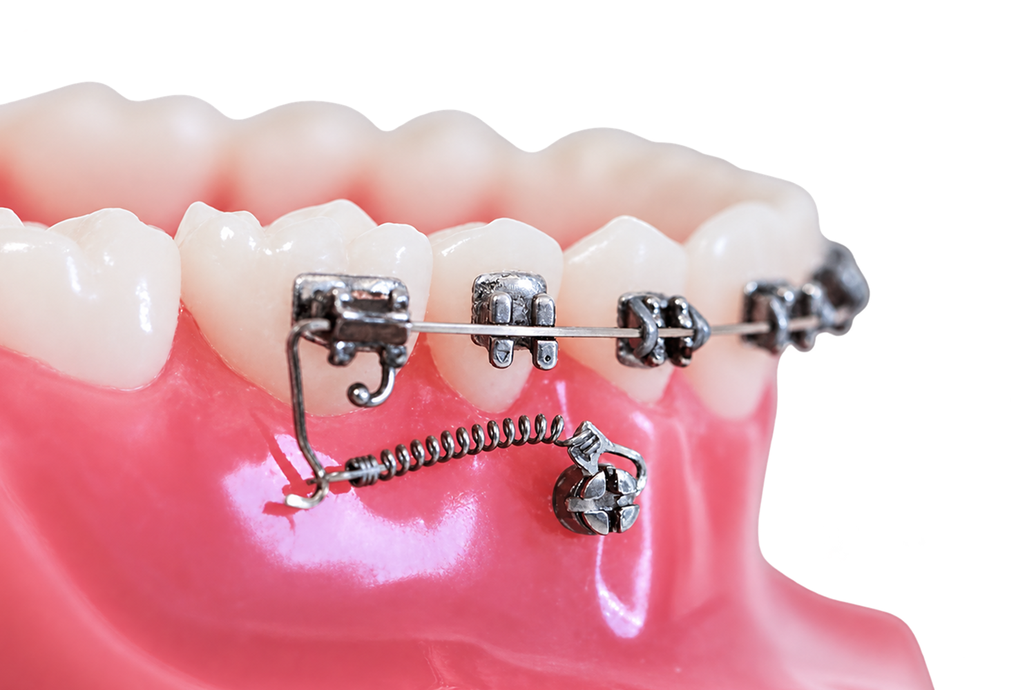 Illustration d’un traitement ortho-chirurgical